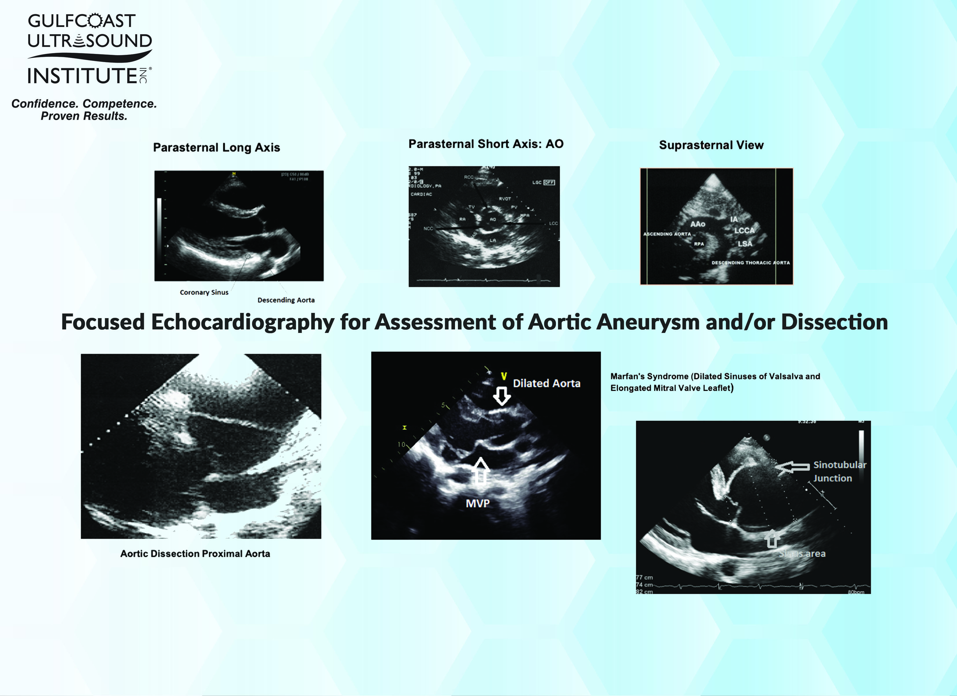 Focused Echocardiography for Assessment of Aortic Aneurysm and/or Dissection